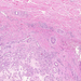 haemangioma capillare cutis átmenet