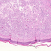 haemangioma capillare cutis0