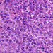 Carcinoma hepatocellulare osztódó