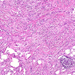 carcinoma lobulare invasivum mammae0