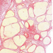 cirrhosis hepatis (picro)0