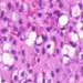 liposarcoma-lipoblast