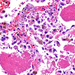 pneumocystis pneumonia középen plazmasejt