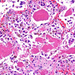 pneumocystis pneumonia-makrophagok