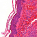 autoimmun vasculitis epidermis