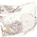 carcinoma ductale invasivum mammae (Er)