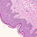 haemangioma capillare cutis norm