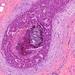 microcalcificatio carcinoma ductale in situ mammae mész=kék